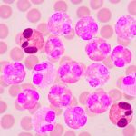 1759575774_leucemia-mieloida-cronica-ce-este-aceasta-boala-simptomele-sale-si.webp.webp